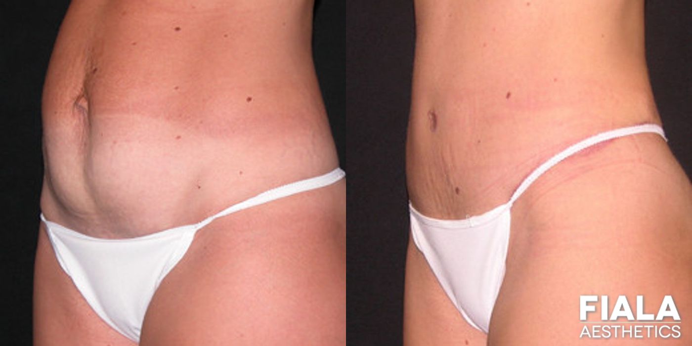 Before and after Tummy Tuck case 13820 - Angle 2