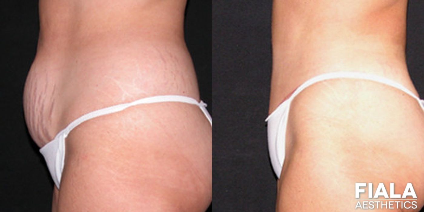 Tummy Tuck - Thumbnail 2