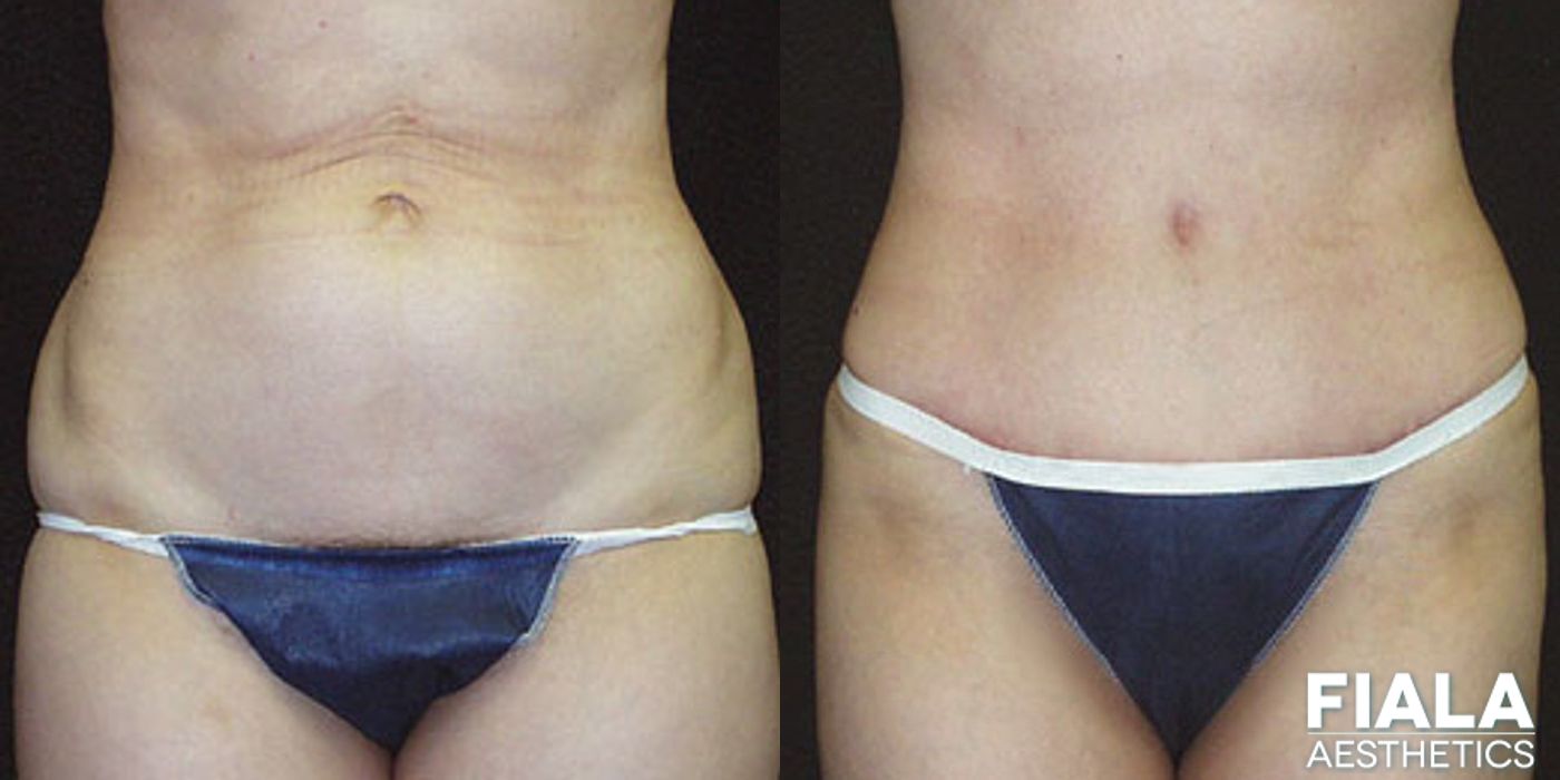 Tummy Tuck - Case 9085