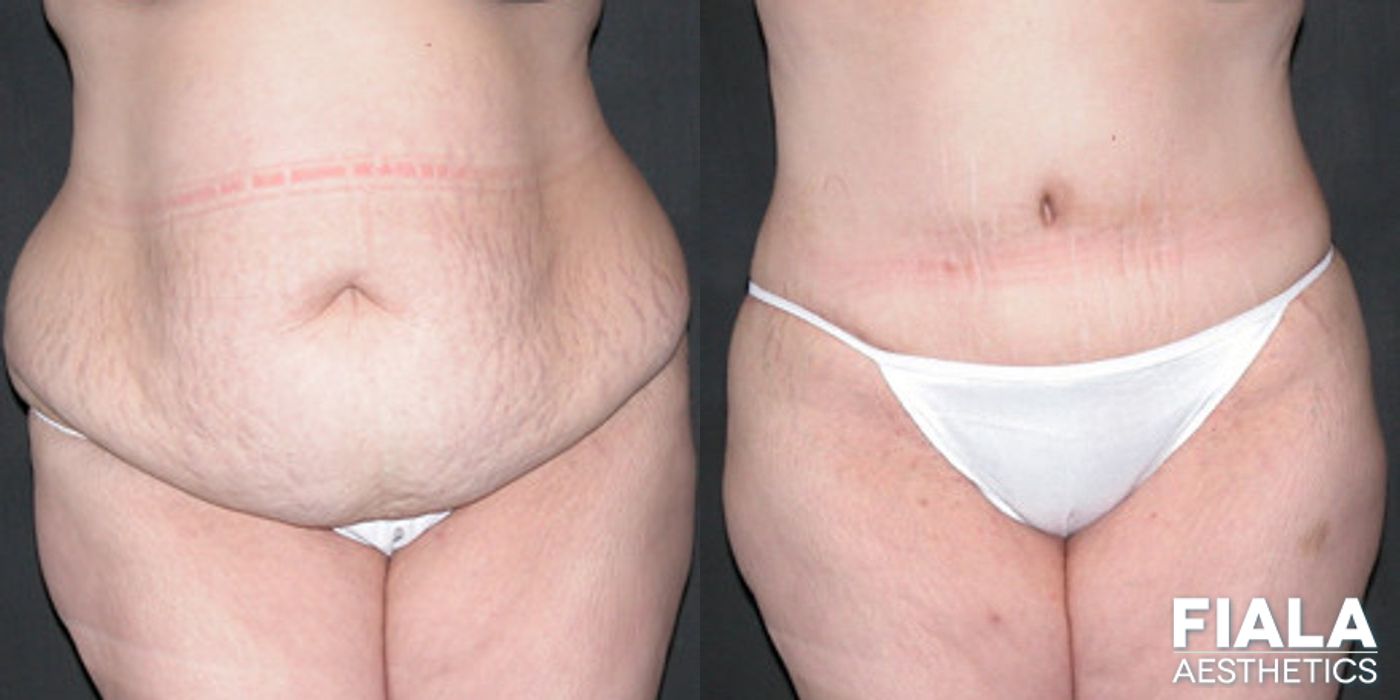 Before and after Tummy Tuck case 13815