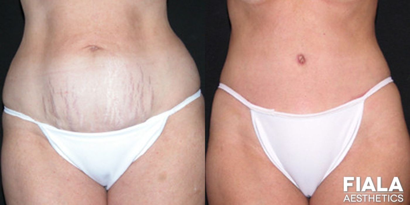 Tummy Tuck - Case 9077