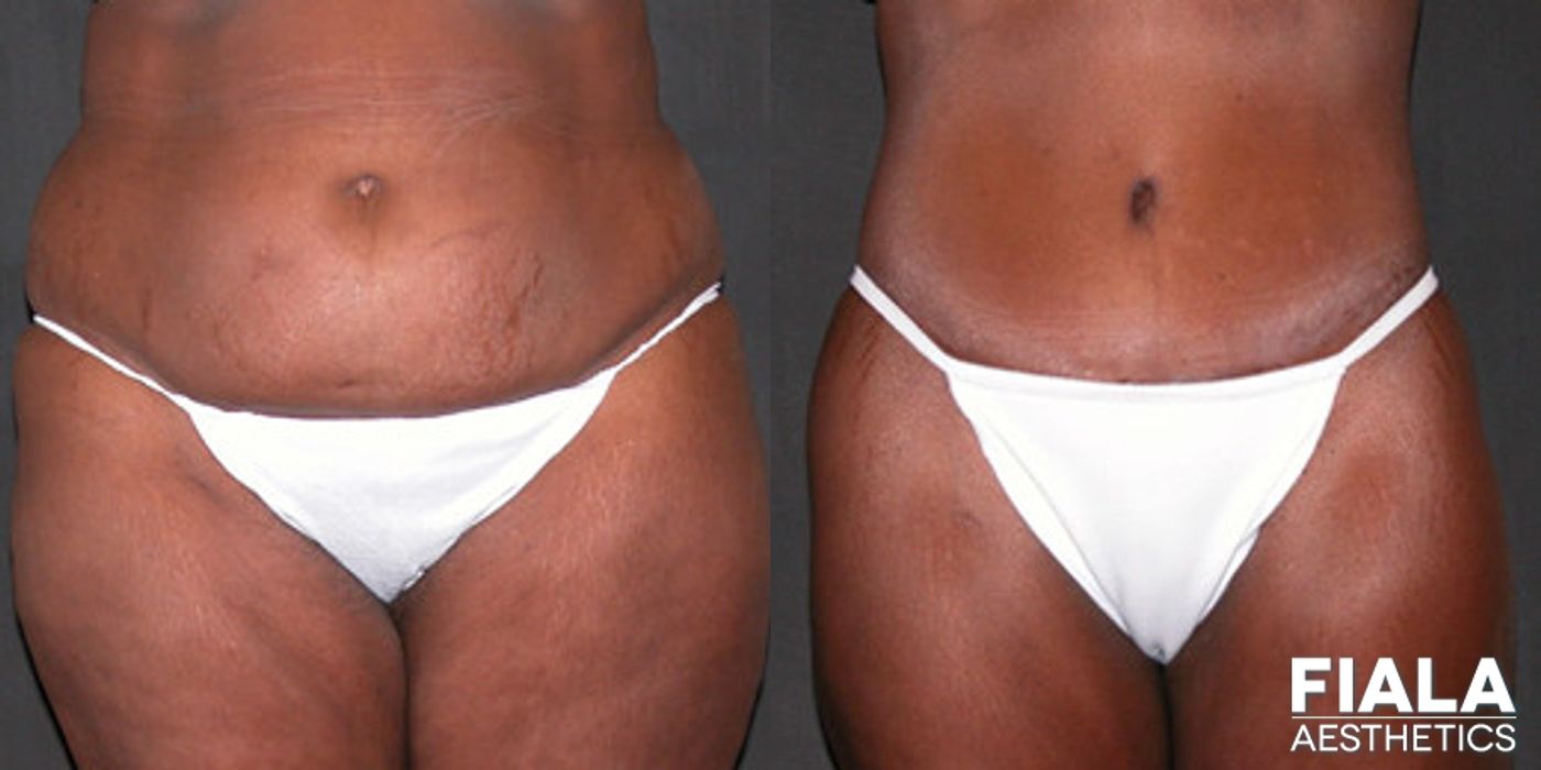 Before and after Tummy Tuck case 13816