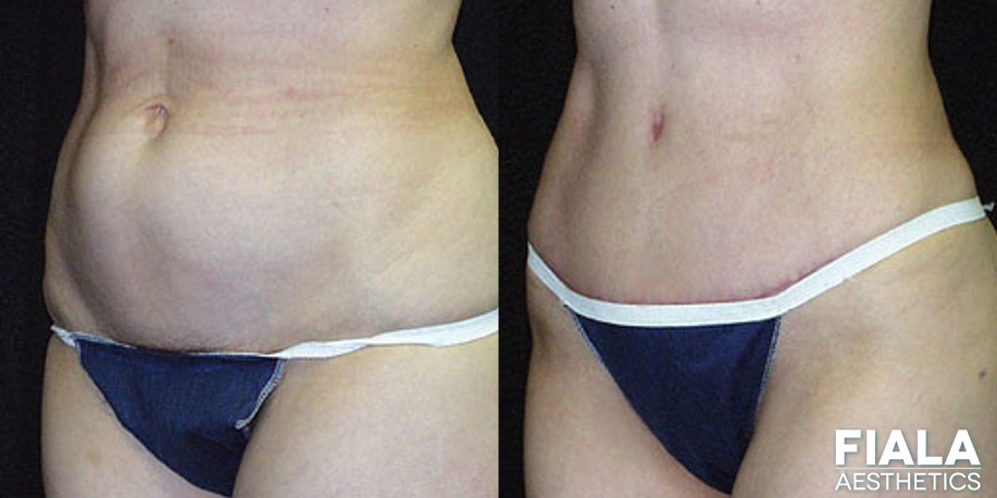 Tummy Tuck - Thumbnail 2