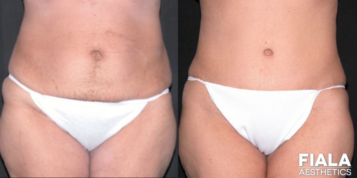 Tummy Tuck - Case 9093