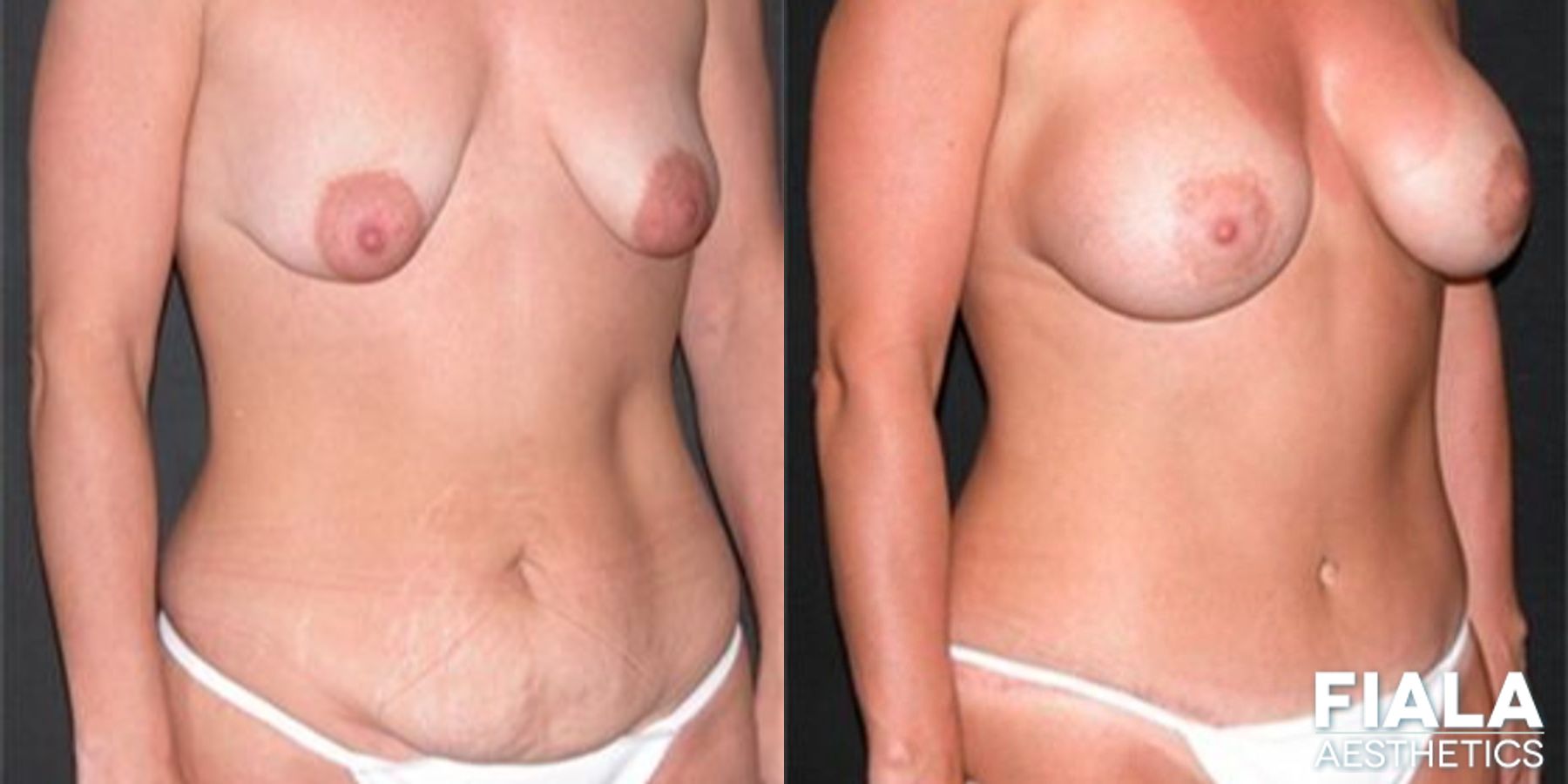 Before and after Tummy Tuck case 14123 - Angle 2