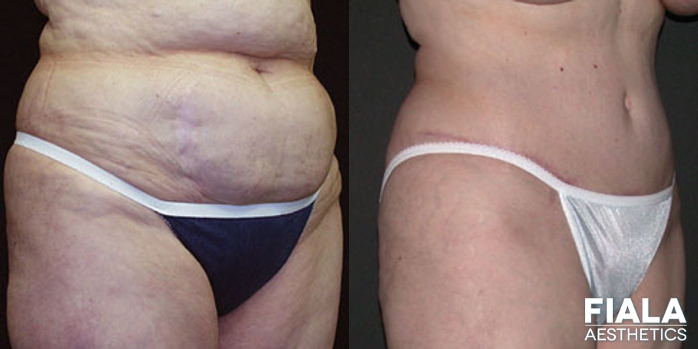 Extended tummy tuck with liposuction showing flatter abdomen and slimmer waistline two months after surgery by Dr. Fiala