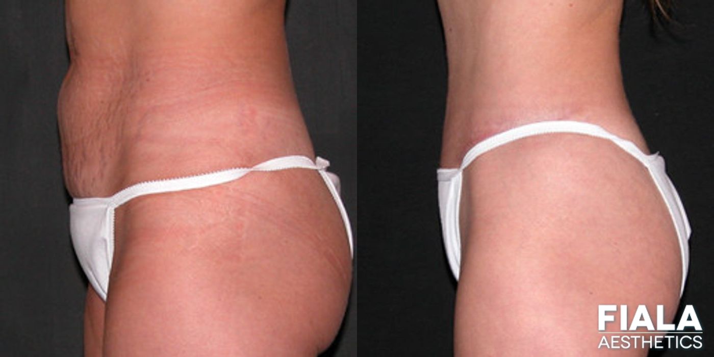 Before and after Tummy Tuck case 13832 - Angle 2