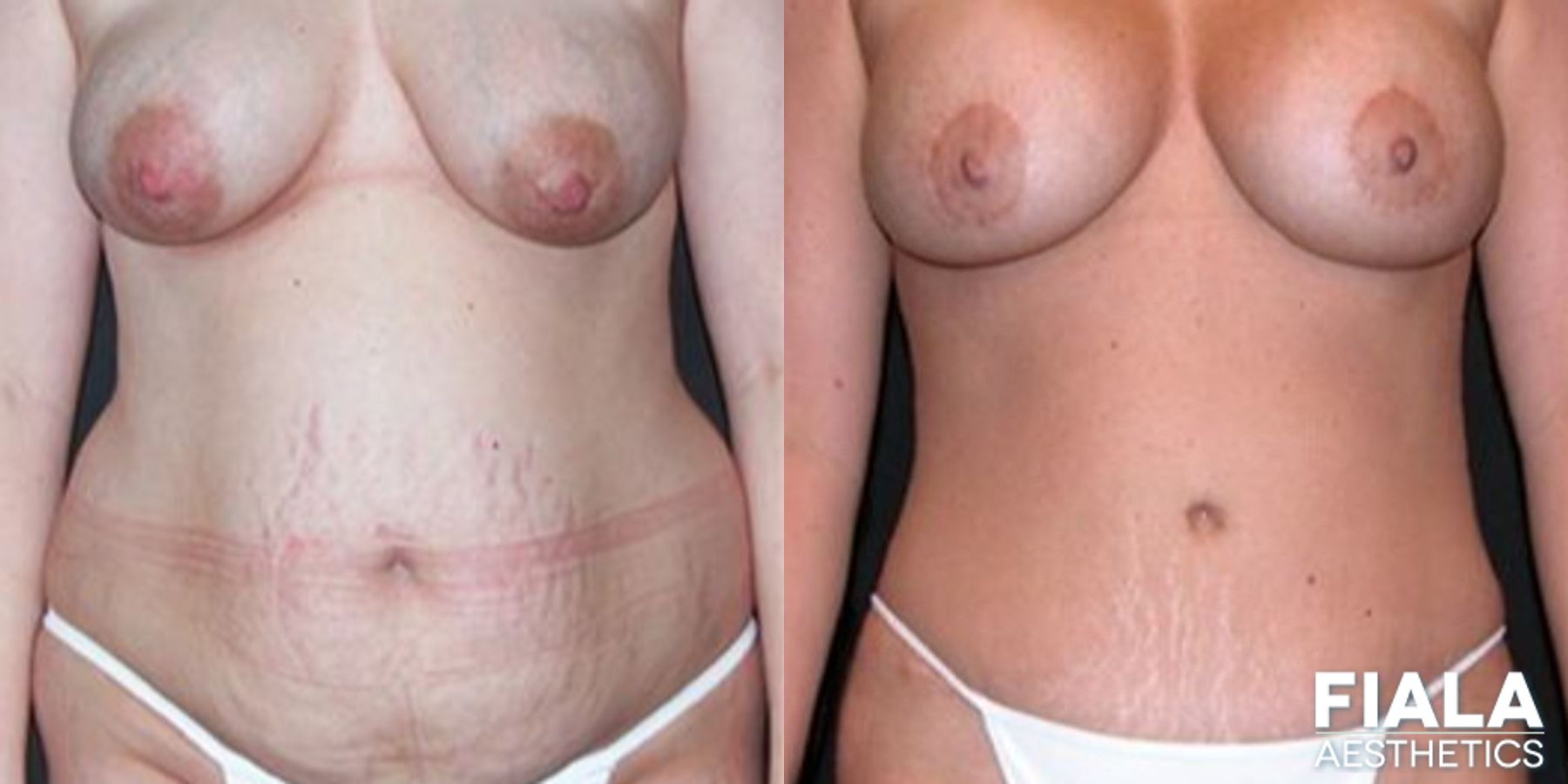 Before and after Tummy Tuck case 14123