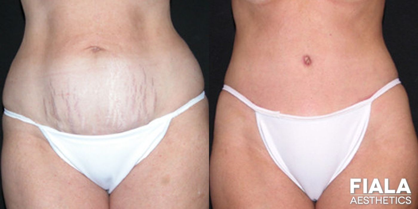 Before and after Tummy Tuck case 13821