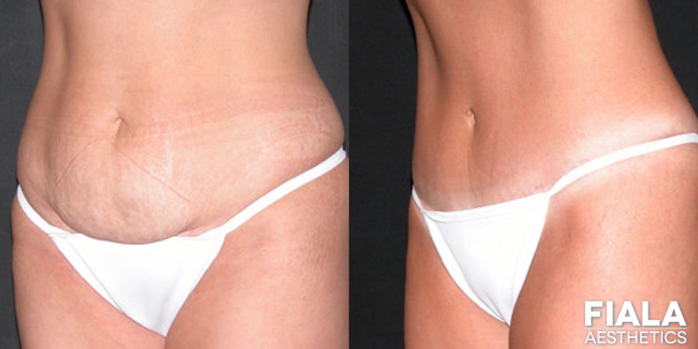 Tummy Tuck - Case 9094
