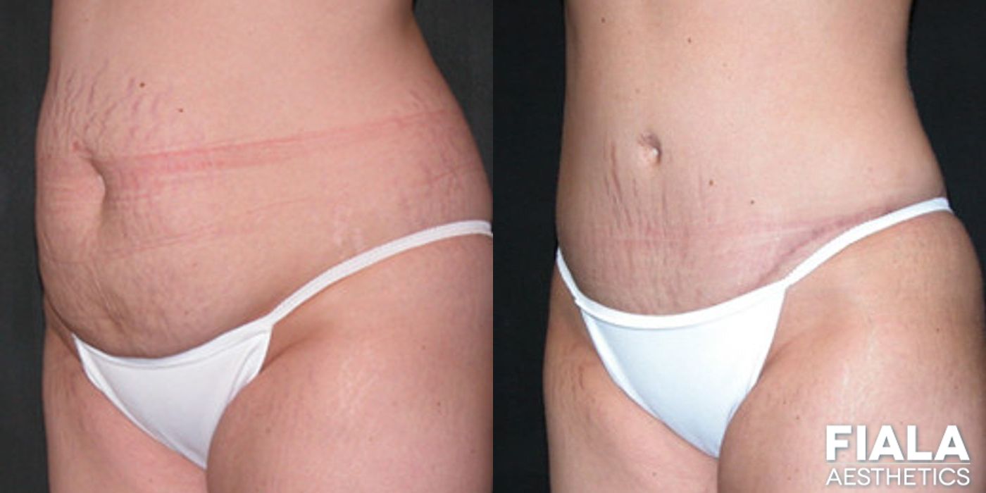 Tummy Tuck - Thumbnail 2