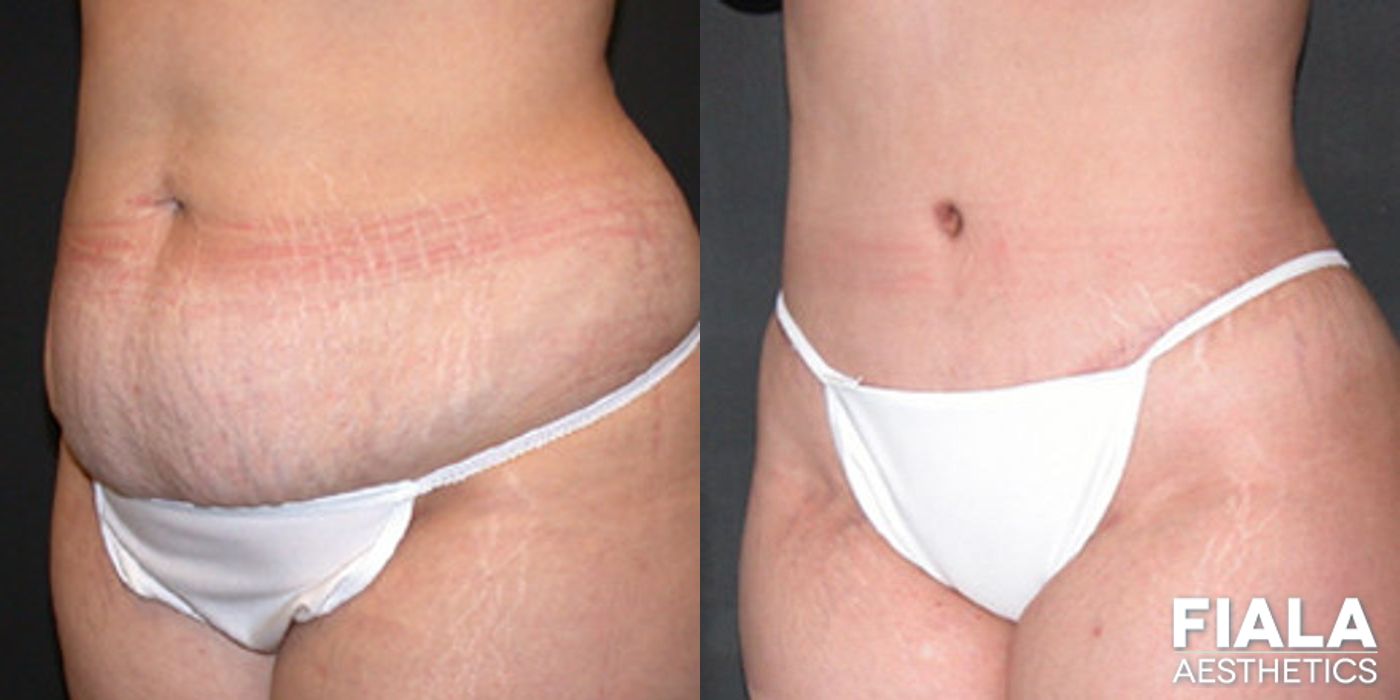 Extended tummy tuck and liposuction two months post-op showing improved midsection definition and natural-looking results by Dr. Fiala - Angle 2