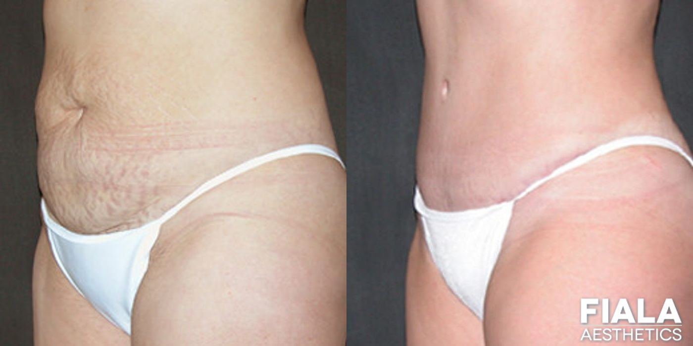 Tummy Tuck - Thumbnail 2