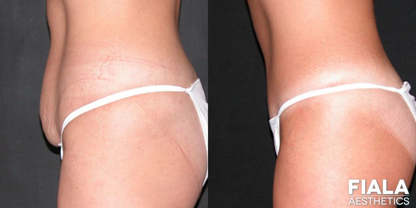 Tummy Tuck - Thumbnail 2