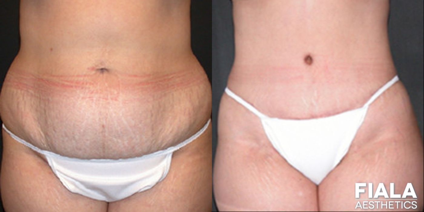 Before and after procedure result