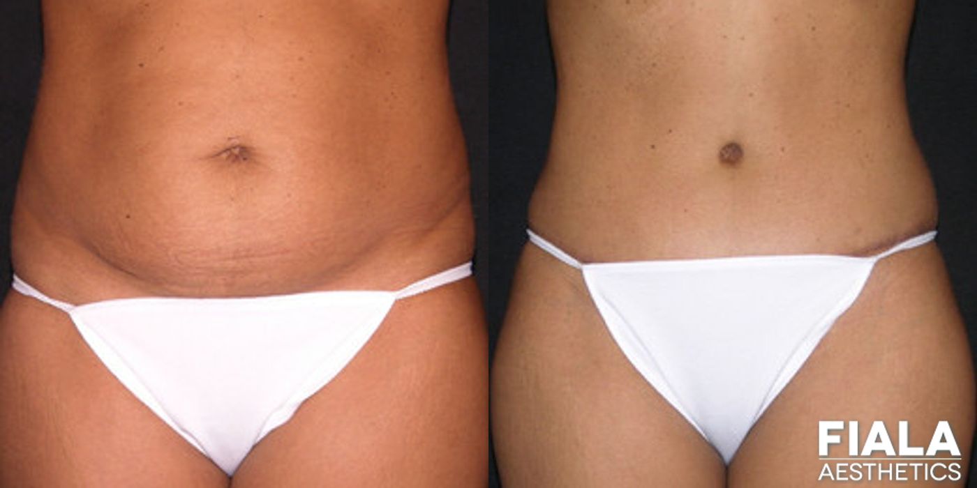 Tummy Tuck - Case 9092