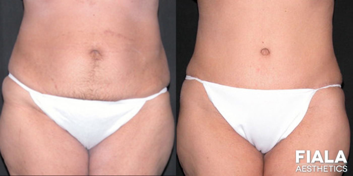 Before and after Tummy Tuck case 13837