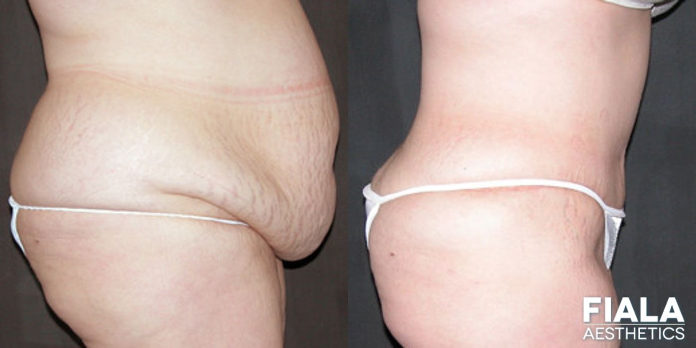 Before and after Tummy Tuck case 13815 - Angle 2