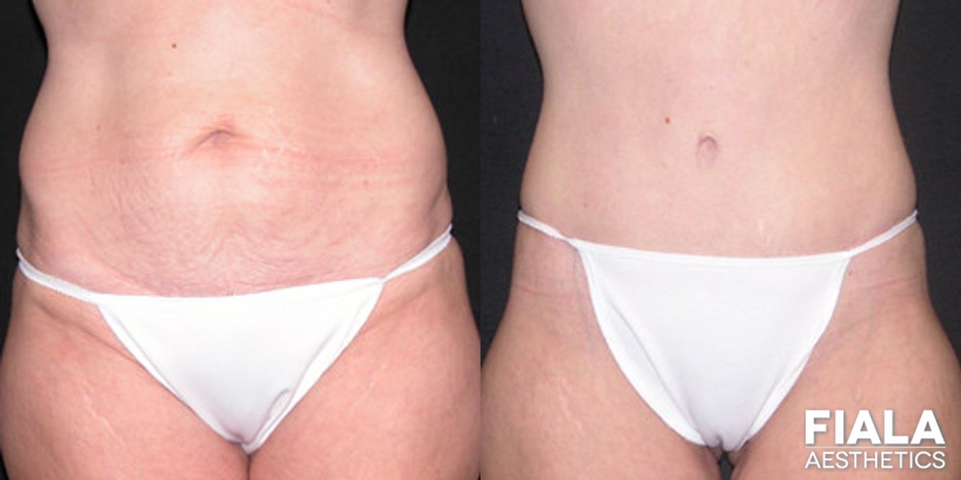 Before and after Tummy Tuck case 13825