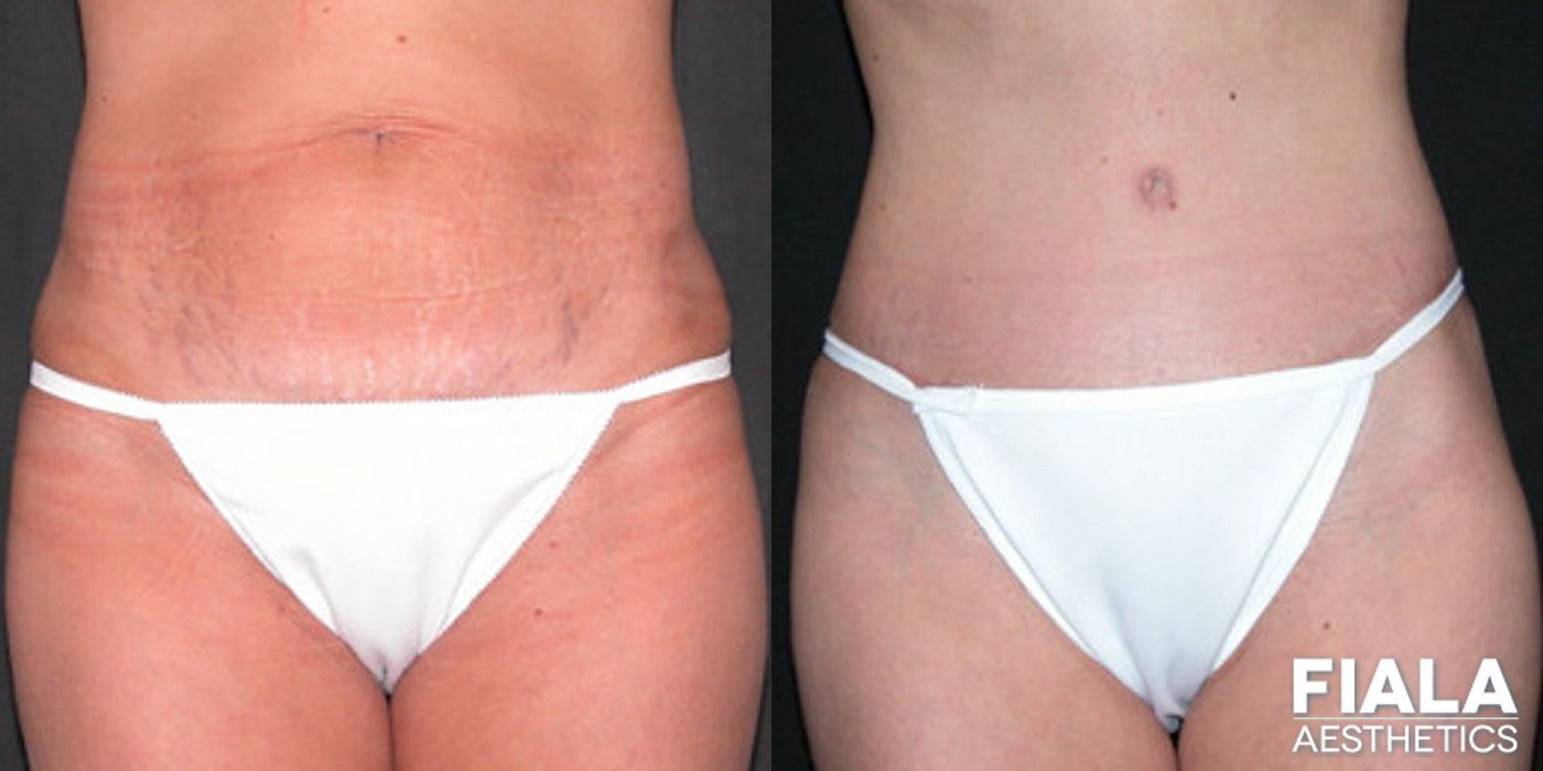 Before and after Tummy Tuck case 13832