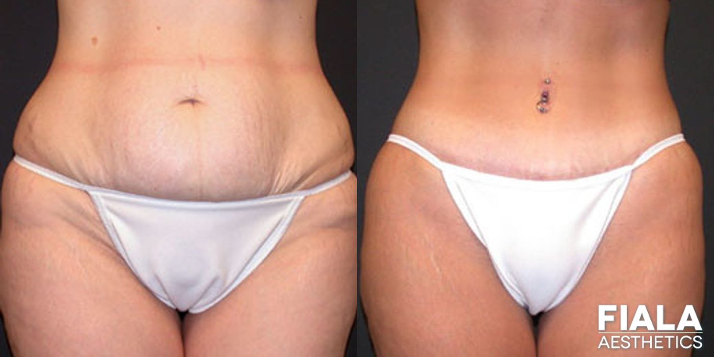 Before and after Tummy Tuck case 13818