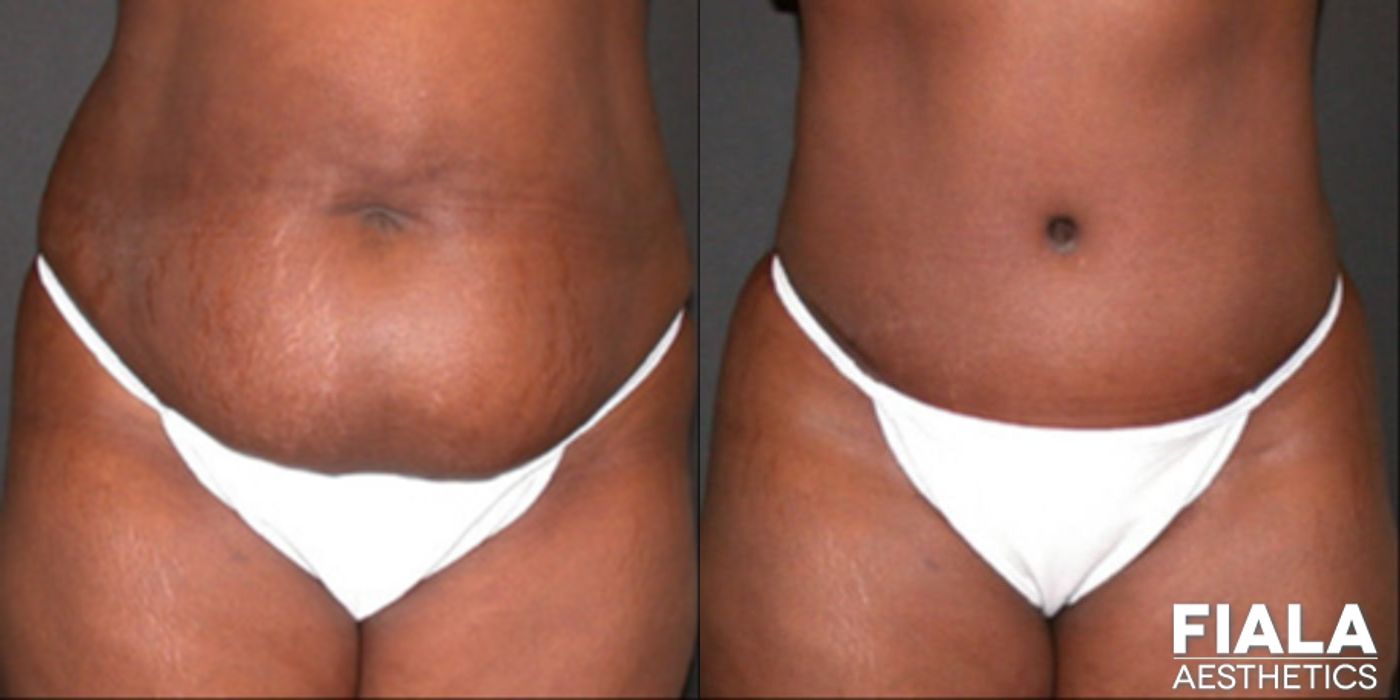 Before and after procedure result