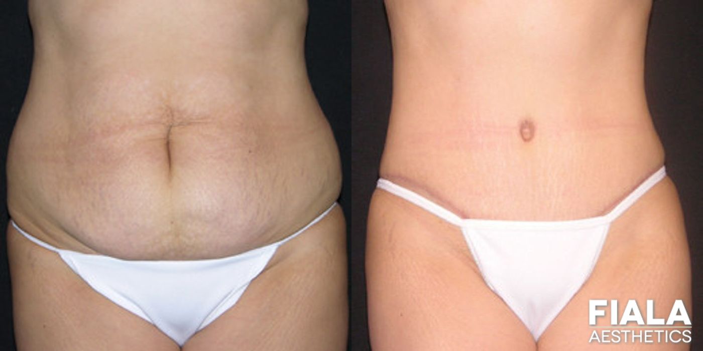 Before and after Tummy Tuck case 13831