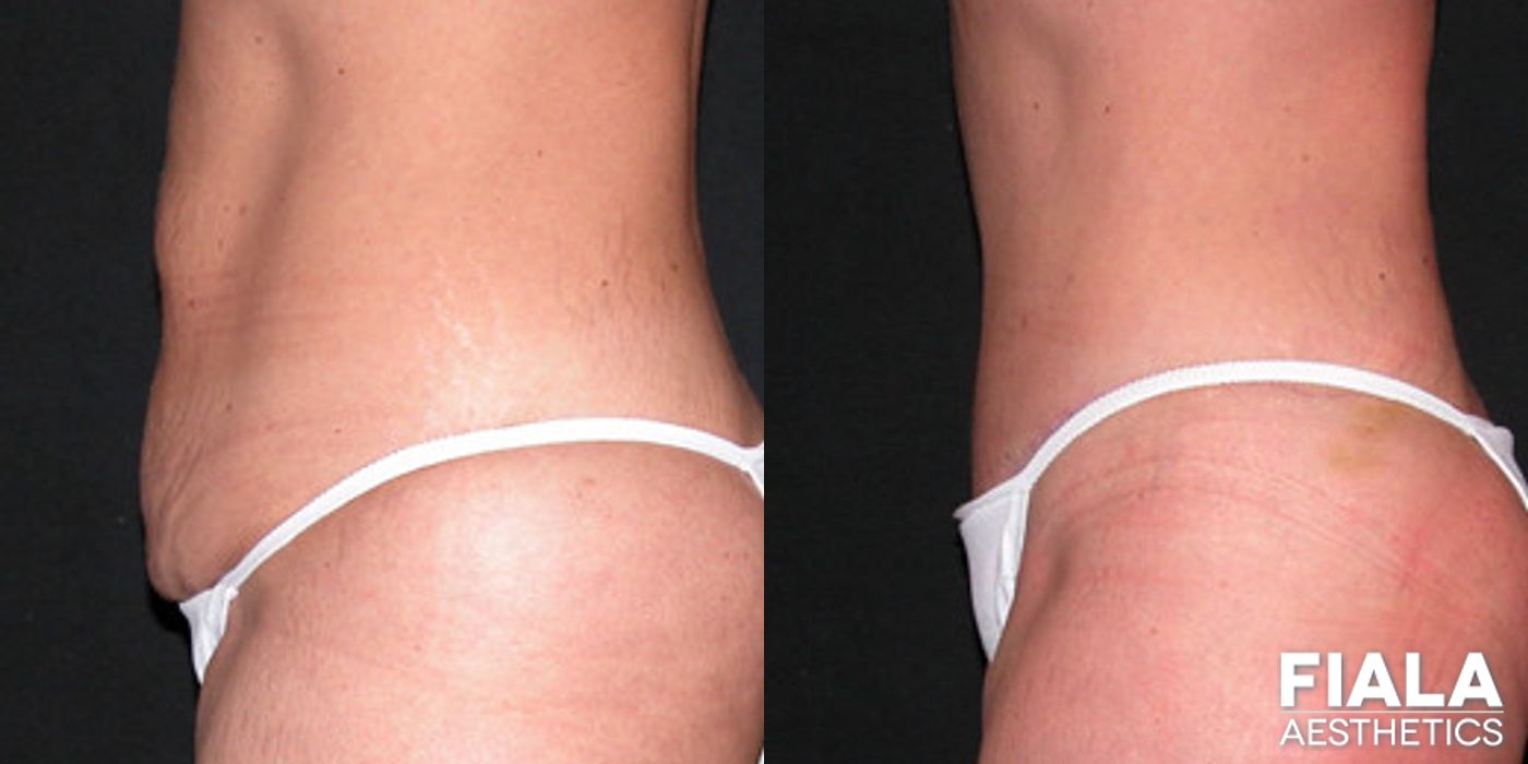 Before and after Tummy Tuck case 13817 - Angle 2