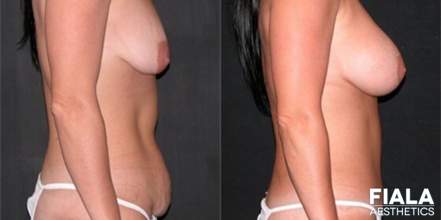 Before and after Tummy Tuck case 14123 - Angle 3