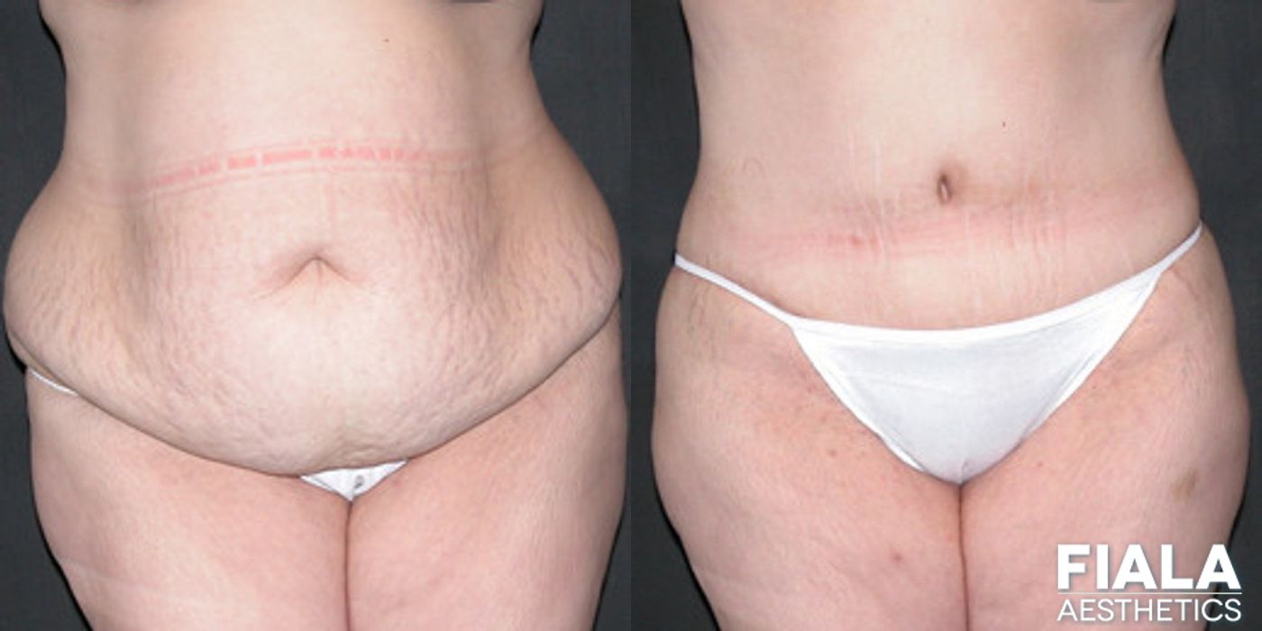 Before and after procedure result