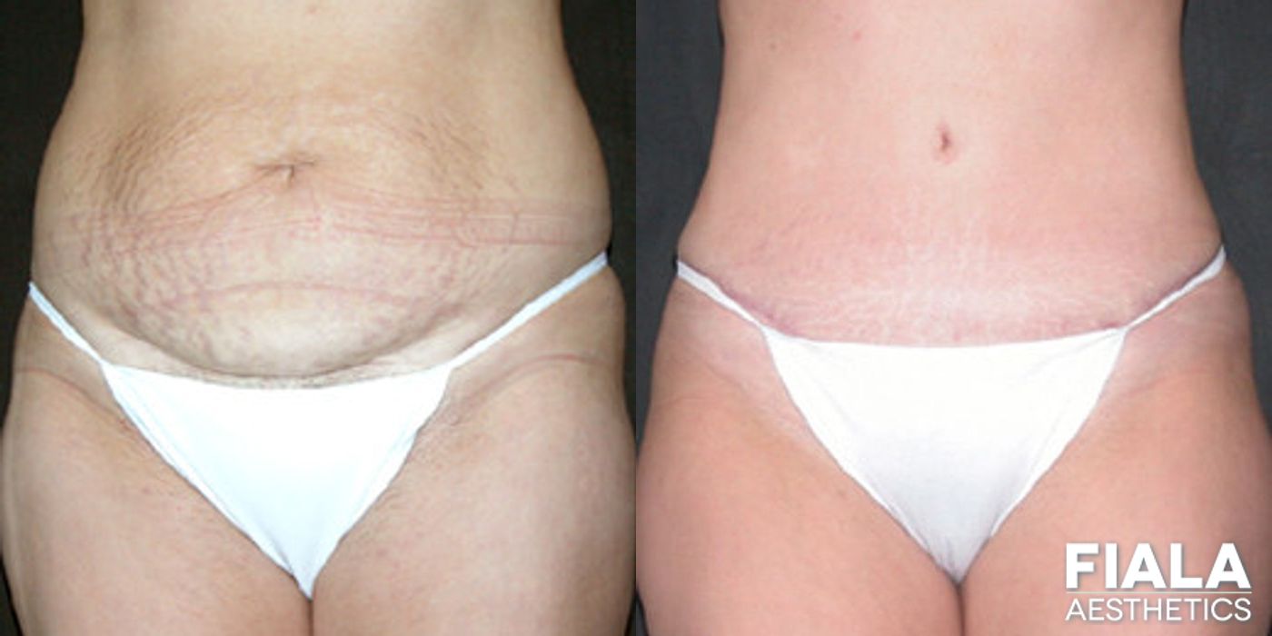 Before and after Tummy Tuck case 13826