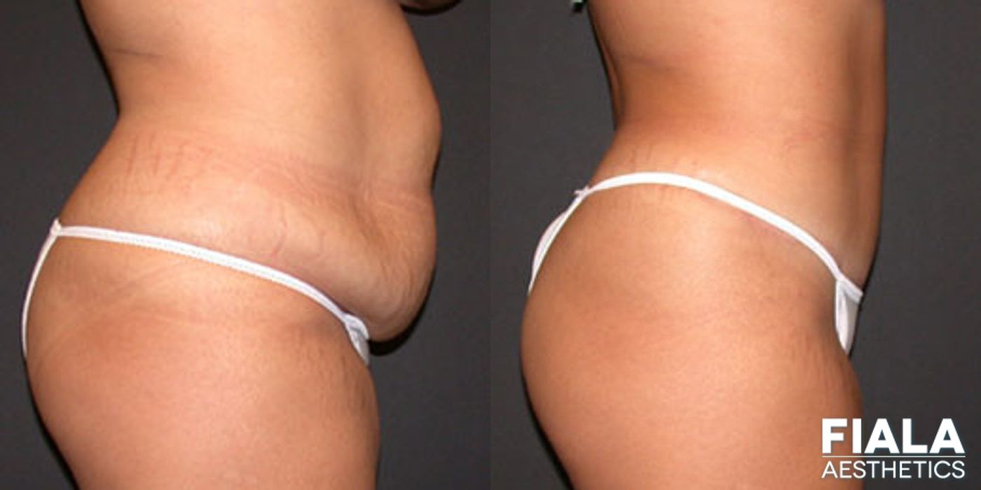 Before and after Tummy Tuck case 13843 - Angle 2