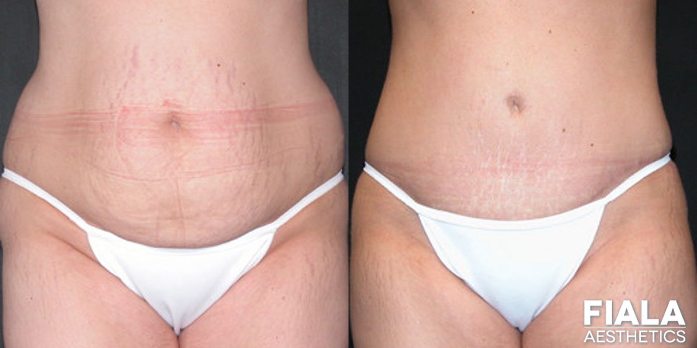 Tummy Tuck - Case 9080