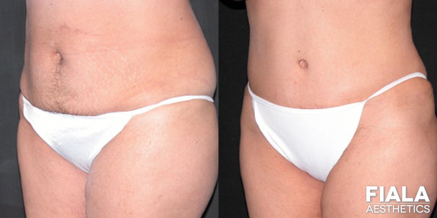Before and after Tummy Tuck case 13837 - Angle 2