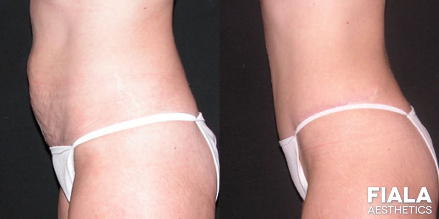 Before and after Tummy Tuck case 13825 - Angle 2