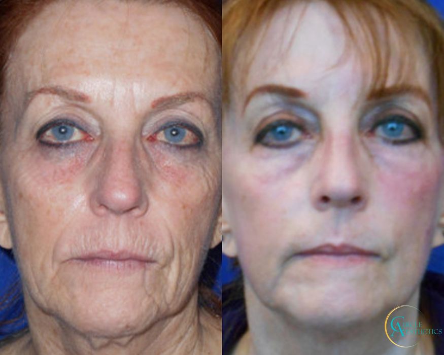 J-Plasma - Case 16667