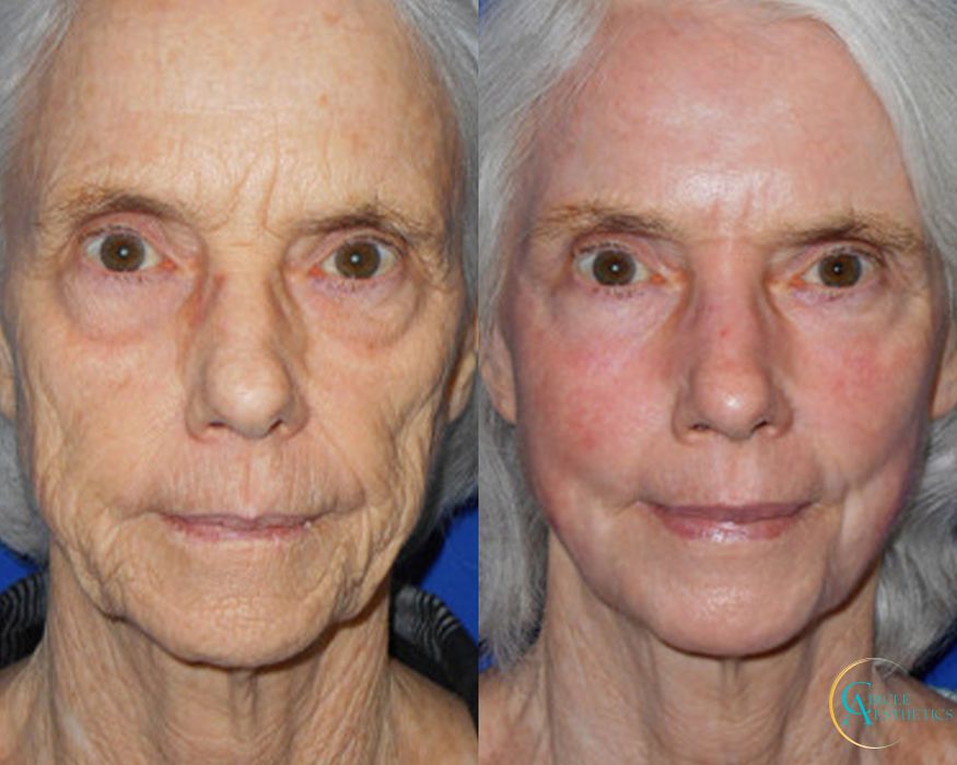 J-Plasma - Case 16669