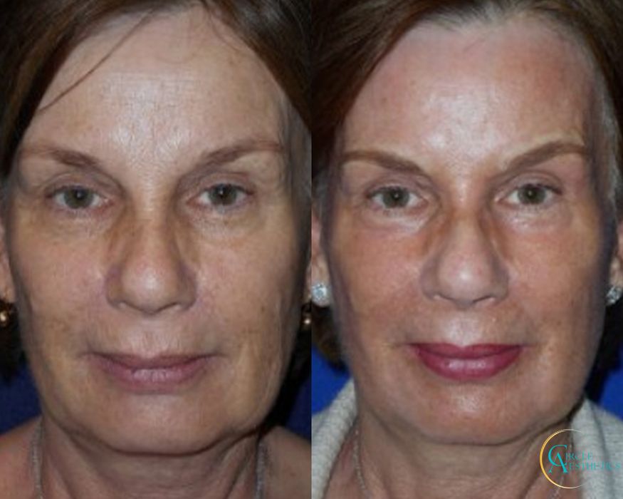 J-Plasma - Case 16664