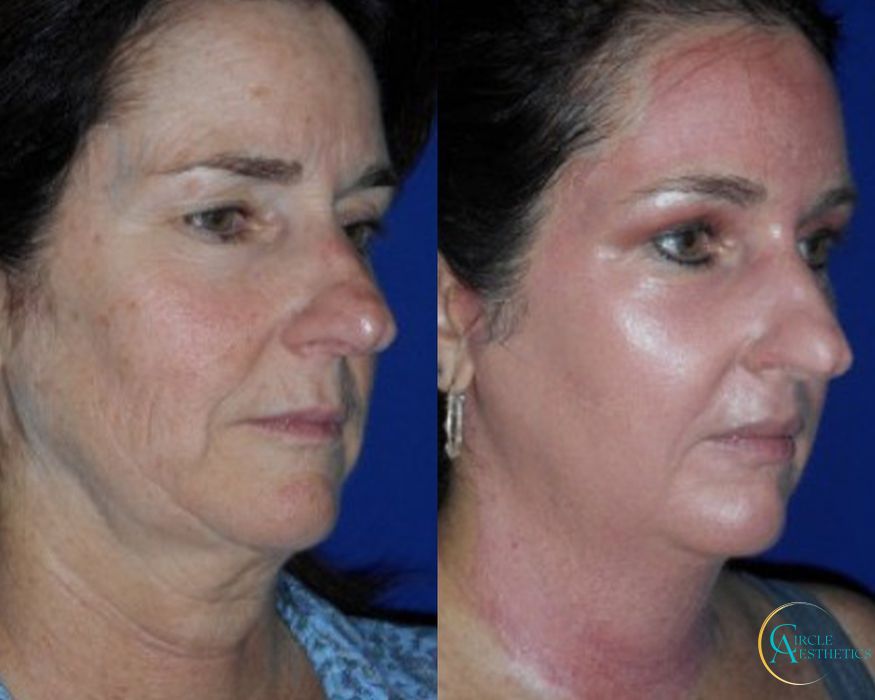 J-Plasma - Thumbnail 2