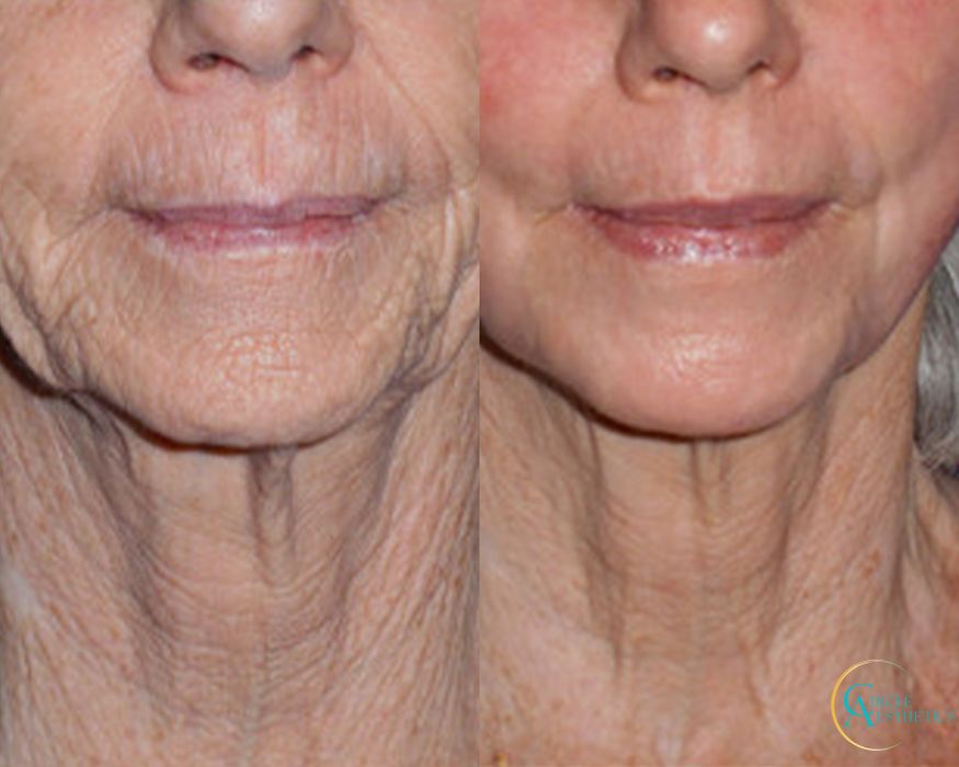 J-Plasma - Thumbnail 2