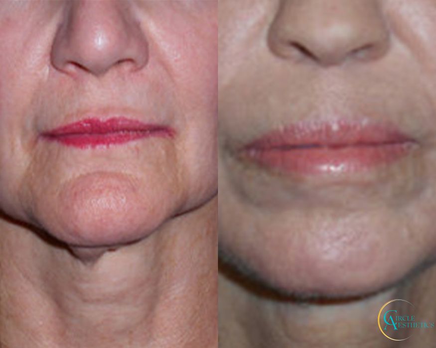 J-Plasma - Thumbnail 2