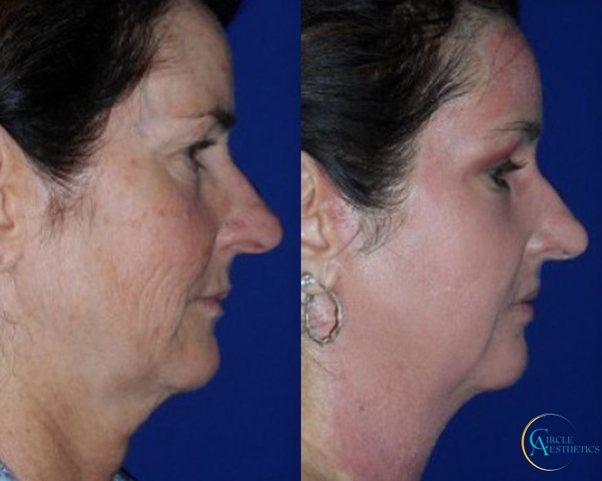 J-Plasma - Thumbnail 3