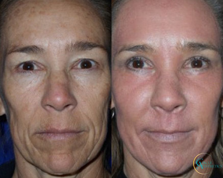 J-Plasma - Case 16666