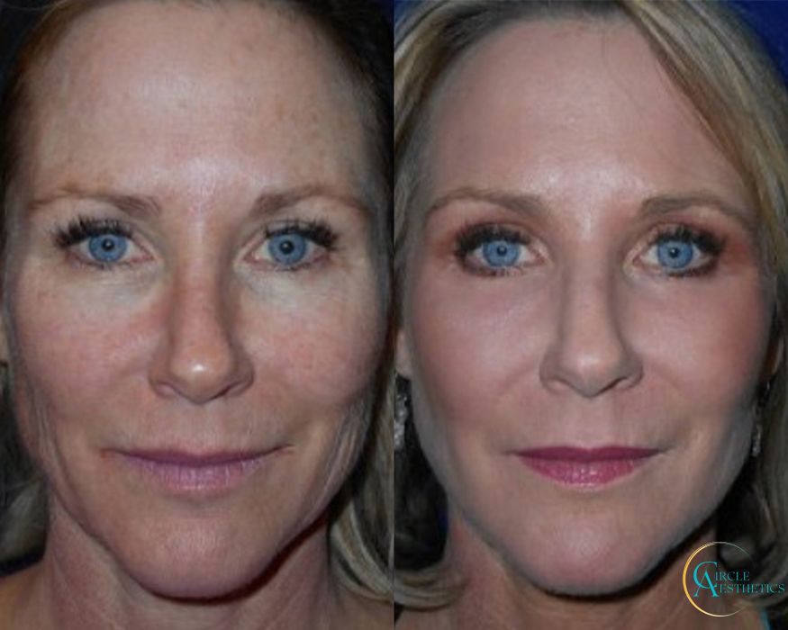 J-Plasma - Case 16668