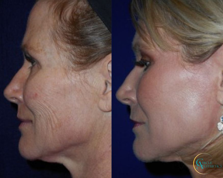 J-Plasma - Thumbnail 3