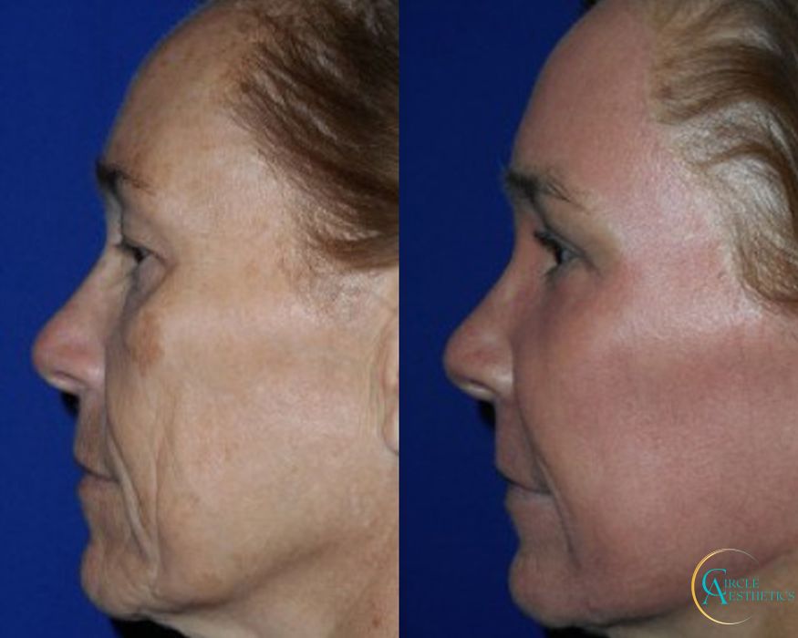 J-Plasma - Thumbnail 3