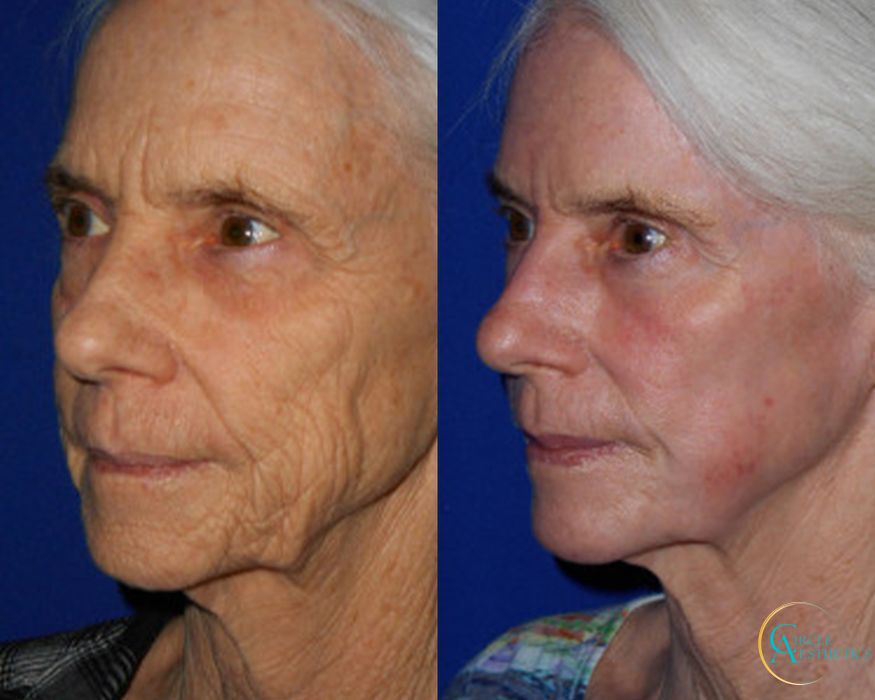 J-Plasma - Thumbnail 3