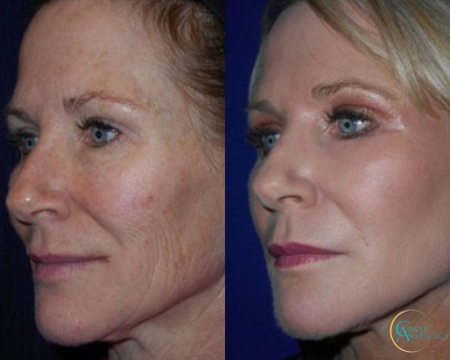 J-Plasma - Thumbnail 2