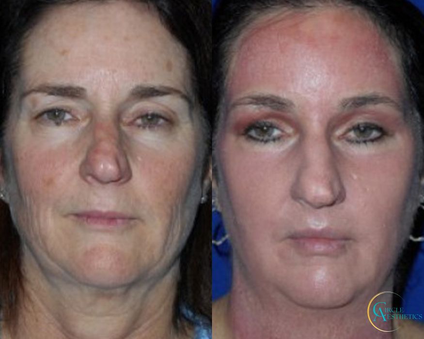 J-Plasma - Case 16665