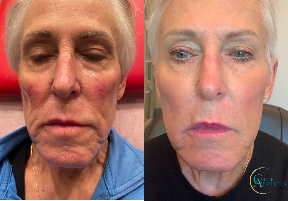 Laser Skin Resurfacing - Case 16672
